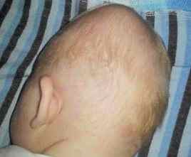 Синяк на голове у ребенка после родов