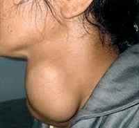 Узловой зоб щитовидной железы у детей