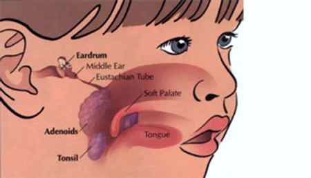 Обострение аденоидита у детей симптомы и лечение