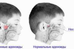 Снять отек носа у ребенка при аденоидах