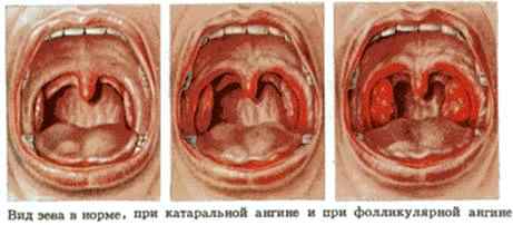 Стрептококковая ангина у детей симптомы