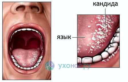 У ребенка грибок в горле