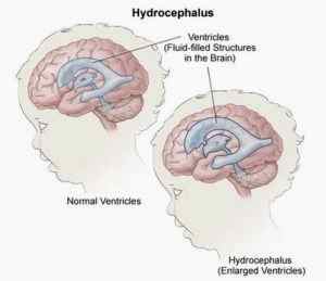 Гидроцефалия головного мозга у детей лечение