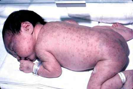 Лечение тромбоцитопенической пурпуры у детей