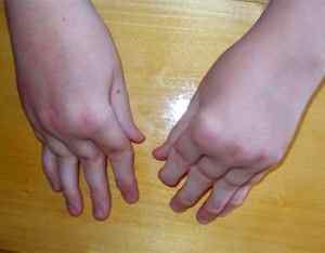 Острый ревматоидный артрит у детей