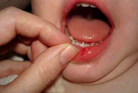 Ушиб губы у ребенка