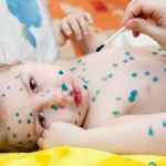 Лечение бронхита у грудных детей комаровский