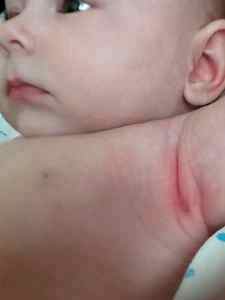 Опрелости у детей лечение комаровский