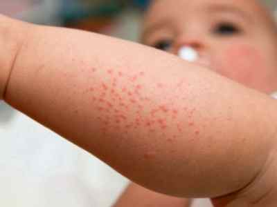 Аллергия на молочный белок у детей симптомы
