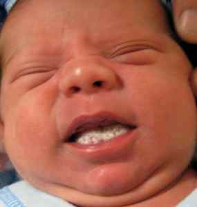 Как выглядит молочница у детей во рту фото