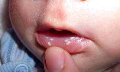 Как выглядит молочница у детей во рту фото
