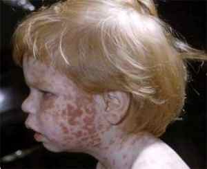 Краснуха у детей симптомы комаровский видео