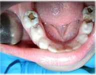 Лечение зубов под наркозом детям красноярск