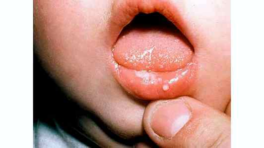 Молочница на губах у ребенка
