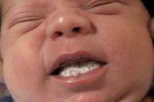 Молочница во рту у ребенка симптомы