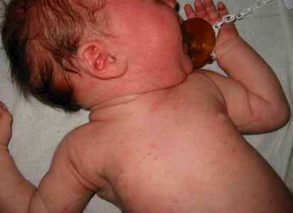 Потница у новорожденных детей фото