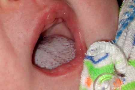 Причины молочницы у детей до года