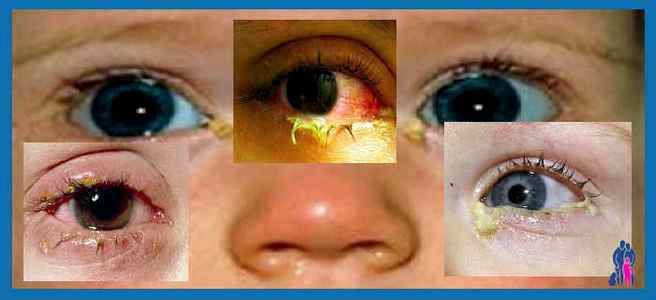 Почему гноятся глаза у ребенка при простуде