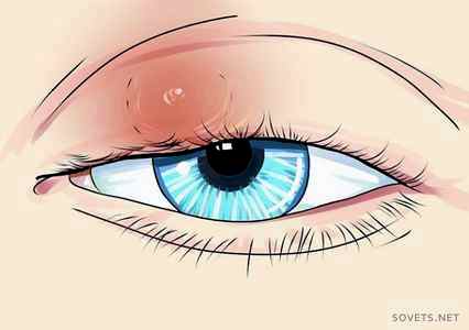 Внутренний ячмень на глазу у ребенка лечение