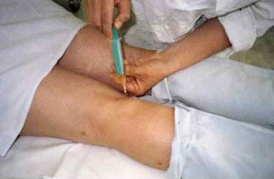Гигрома под коленом у ребенка лечение