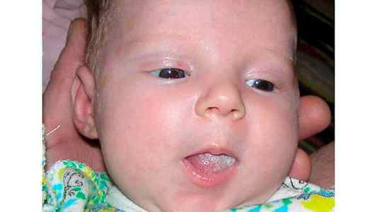 Белый налет на языке у месячного ребенка