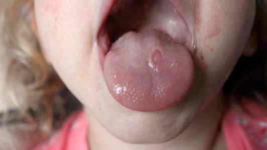 Чем лечить ранки на языке у ребенка