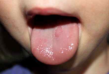 Чем лечить ранки на языке у ребенка