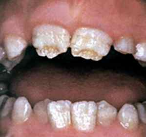 Дисплазия зубной эмали у детей 8 лет