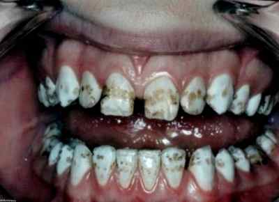 Флюороз зубов у детей реферат