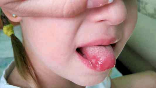 Киста на кончике языка у ребенка