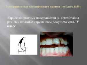 Классификация кариеса зубов у детей по степени активности