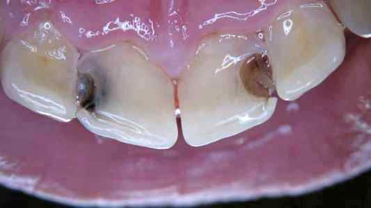 Лечение кариеса передних зубов у детей