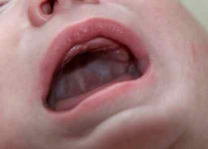 Стоматит на щеке у ребенка фото