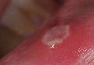Стоматит на щеке у ребенка лечение