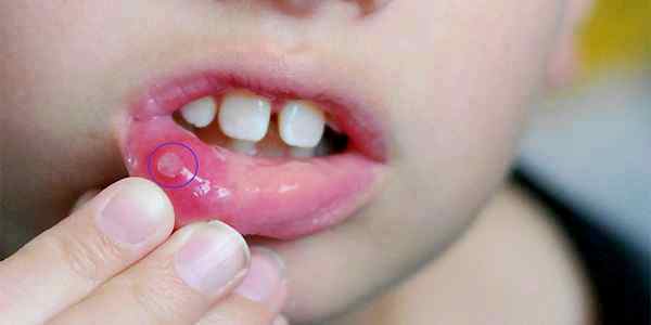 Стоматит у детей лечение препараты
