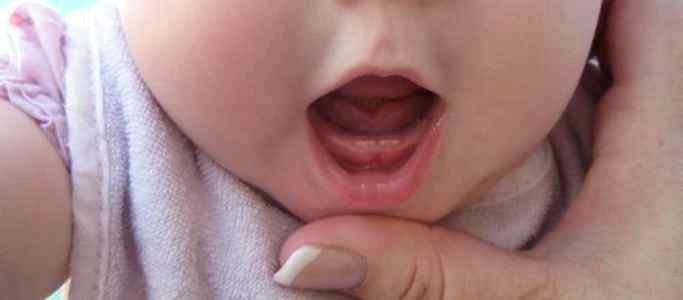 Стоматит у грудных детей