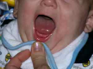 Температура у ребенка лезут зубы