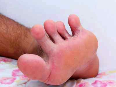 Лечение грибка между пальцами ног у детей