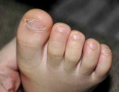 Лечение грибка между пальцами ног у детей