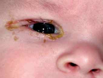 Респираторный хламидиоз у детей симптомы