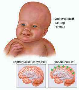Болезнь гидроцефалия у детей