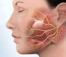 Неврит лицевого нерва у детей лечение