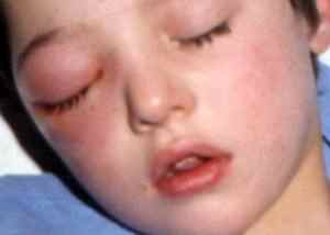 Острый этмоидит у детей лечение