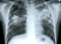 Первые симптомы туберкулеза у детей в год