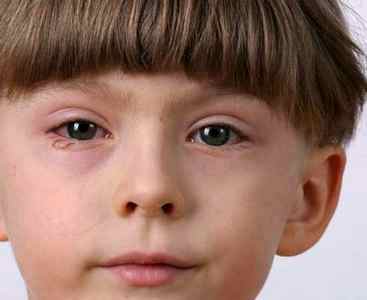 Реактивный артрит у детей диагностика