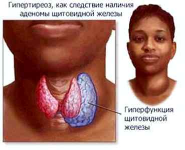 Щитовидка у детей