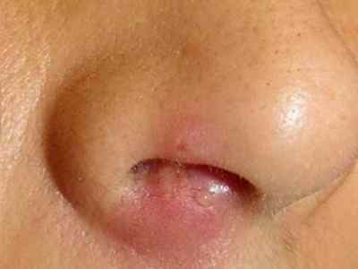 Стафилококковая инфекция у детей в носу