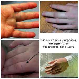 Ушиб пальца у ребенка на руке что делать