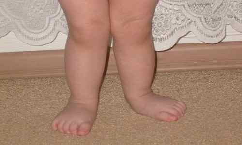 Вальгус коленных суставов у детей массаж видео