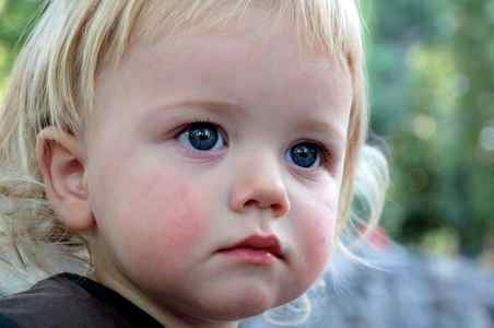 Диатез на лице у ребенка 3 года